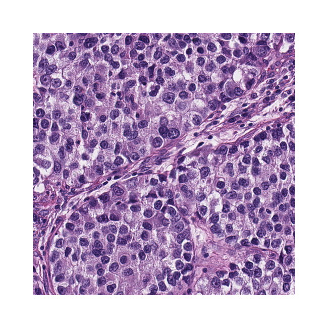 20_AI_cancer_lung_paper